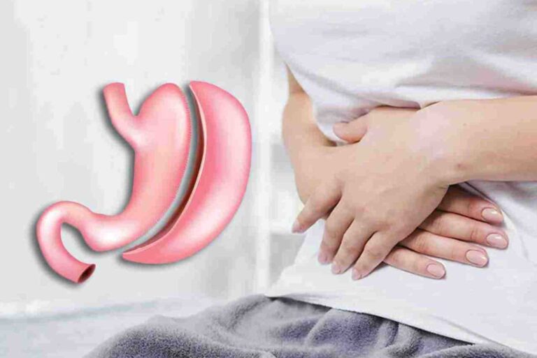 تكميم المعدة